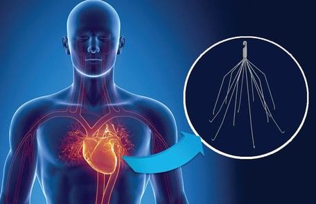 IVC FILTER